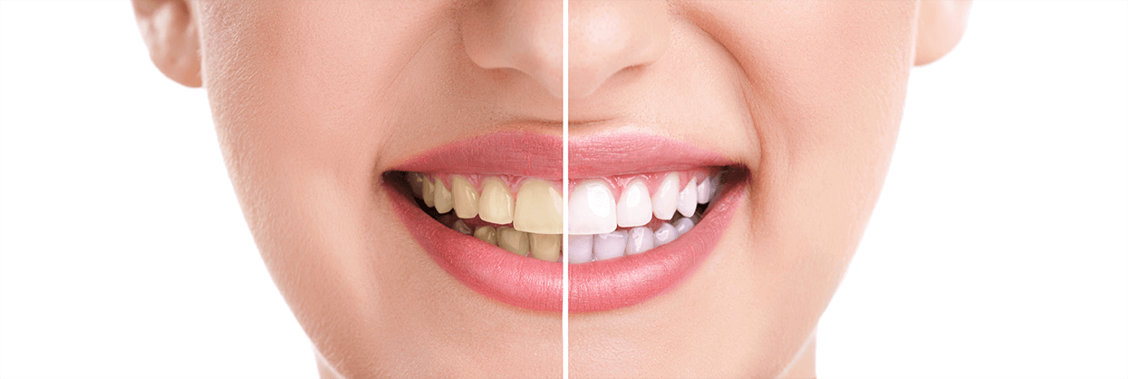 Teeth Whitening in Trumbull, Connecticut